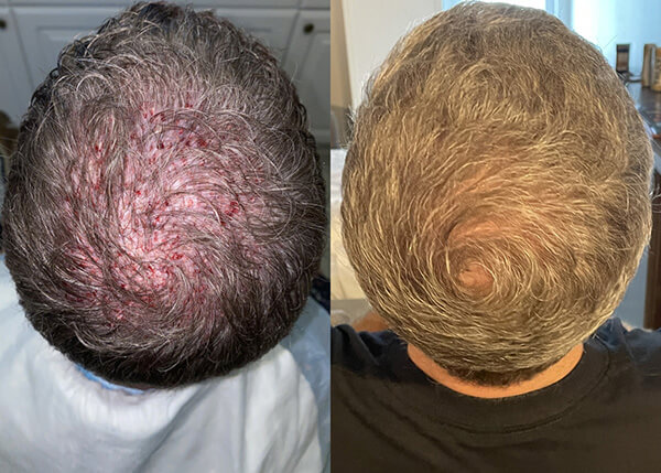 hair transplant Crown photos